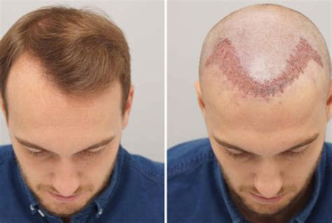 Hair Transplant Turkey – Could It Help You Permanently Overcome Hair Loss?